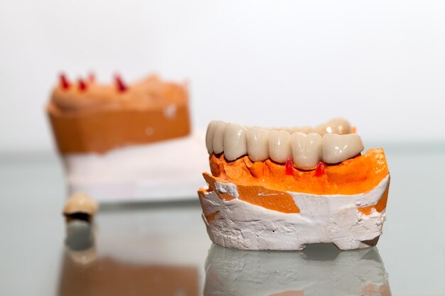 Zahnplatte aus Zirkoniumporzellan im Zahnarztgeschäft Foto