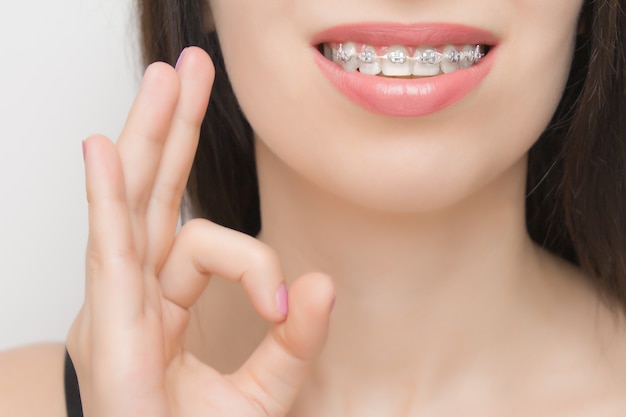 Zahnspangen im mund einer glücklichen frau, die ok zeigt. brackets an den zähnen nach dem aufhellen. selbstligierende halterungen mit metallbindern und grauen gummibändern oder gummibändern für ein perfektes lächeln