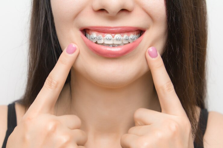 Zahnspangen im Mund einer glücklichen Frau, die sich nach dem Aufhellen mit zwei Fingern an den Zahnspangen zeigen. Selbstligierende Halterungen mit Metallbindern und grauen Gummibändern oder Gummibändern für ein perfektes Lächeln