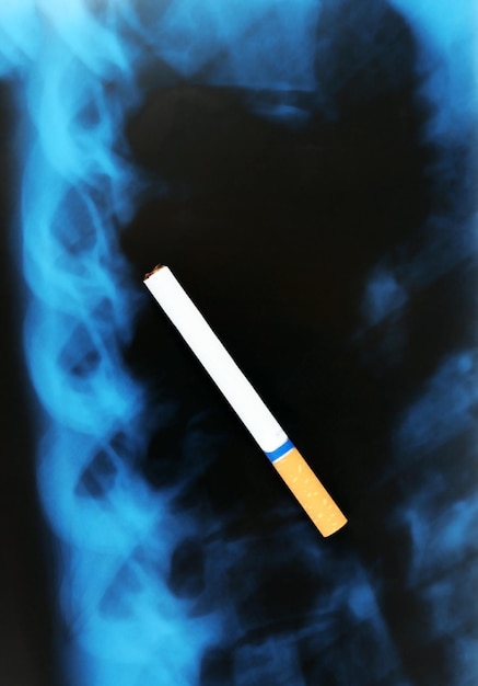 Zigarette auf Röntgenlunge aus nächster Nähe