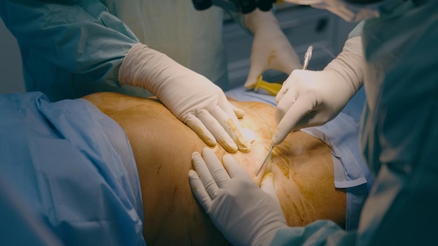 Zwei Ärzte, Männer, Chirurg, Arzt, Mediziner, helfen dem Patienten bei der plastischen Operation des Bauches, des Bauches.