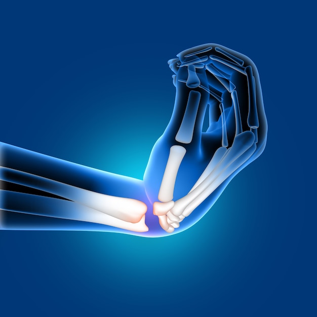 고통스러운 구부러진 손목의 3D 의료 이미지