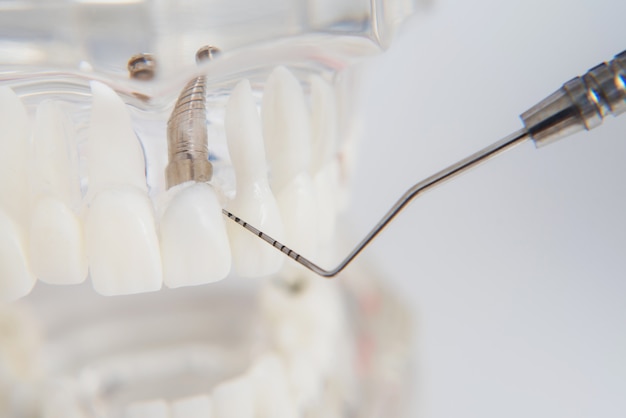 Модель зубов с имплантатами лежит на столе