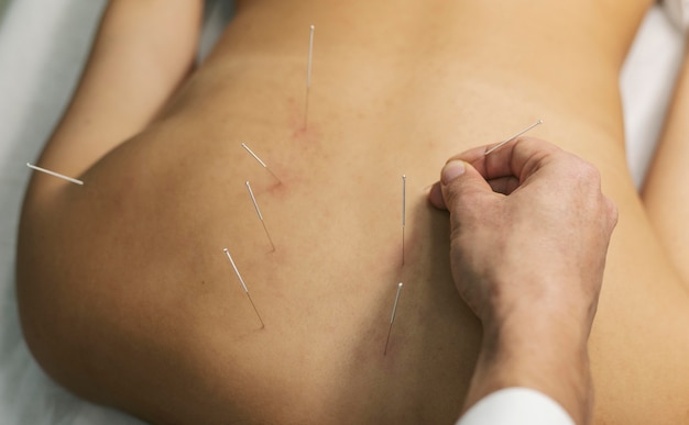 Free photo acupuncture process close up