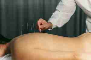 Free photo acupuncture process