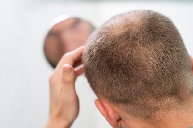 Adult male having balding problems