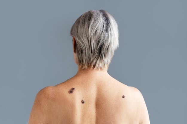 Back view senior woman with melanoma