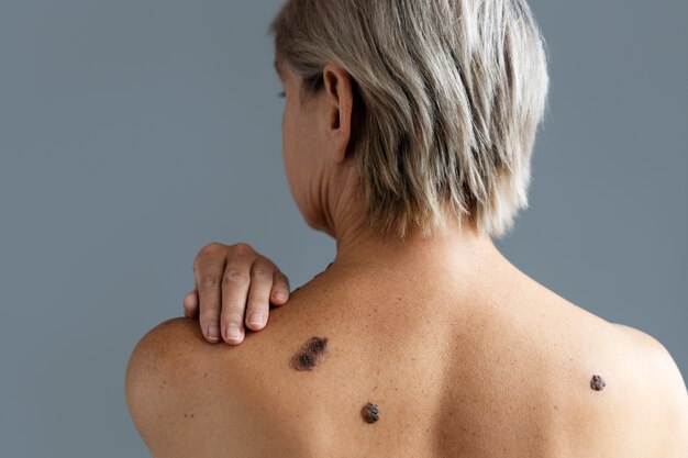 Back view woman with skin cancer