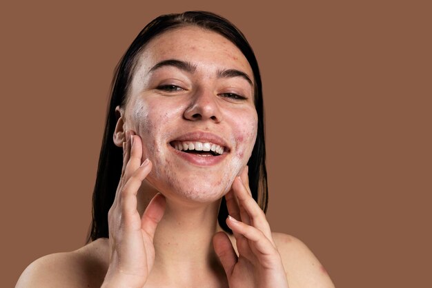 Beautiful woman showing her acne with confidence