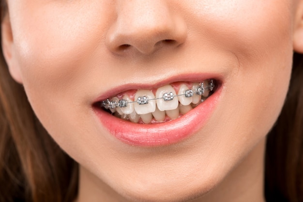 Beautiful young woman with teeth braces