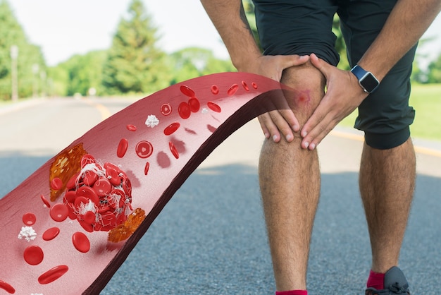 Blood clots in legs disease