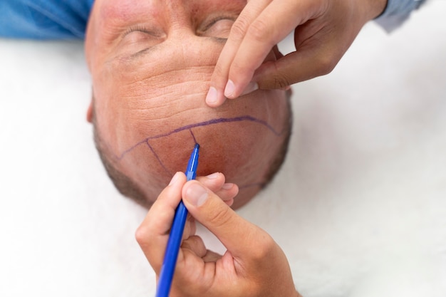 Bold man going through a follicular unit extraction process