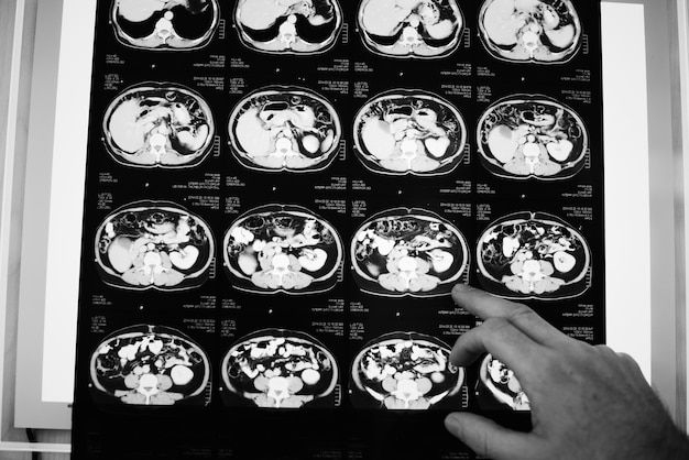 뇌 CT 스캔 X 선 필름