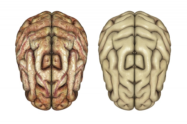 Foto gratuita 3d rendono di due cervelli uno sano e uno malato