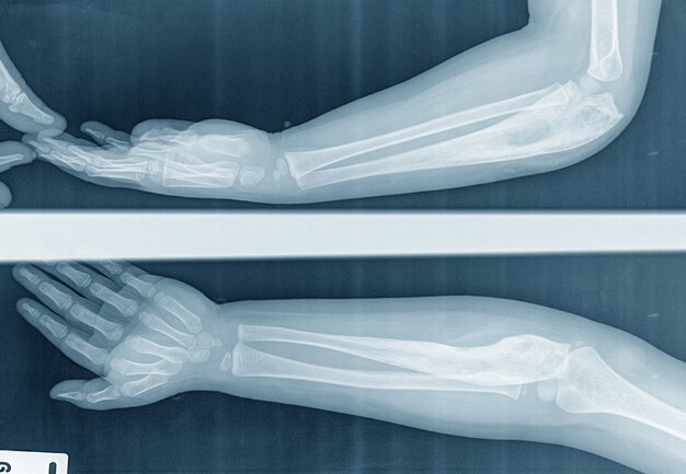 A child xray elbow lateral ap view of the forearm caused by bone cancerosteosarcoma of the ulna