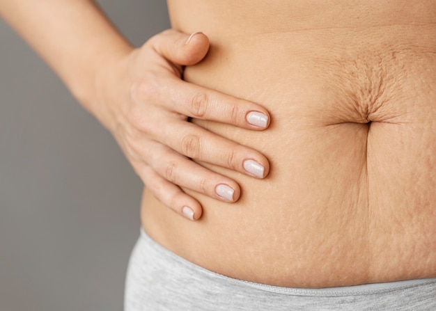 Close up beautiful woman with stretch marks