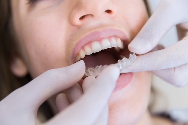 Close-up of a dentist's hand fixing transparent aligner to female patient's teeth