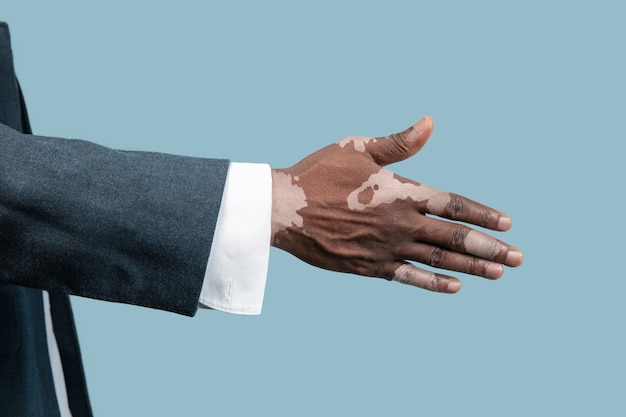 Close up of male hands with vitiligo pigments isolated on blue background.Special skin