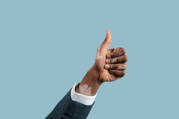 Close up of male hands with vitiligo pigments isolated on blue  background.