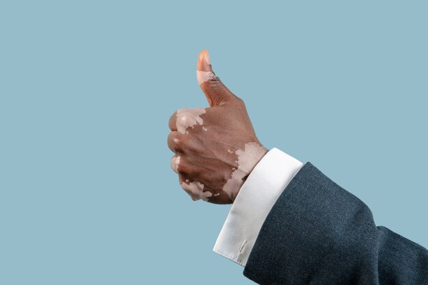 Close up of male hands with vitiligo pigments isolated on blue studio background.