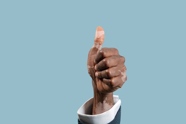 Free photo close up of male hands with vitiligo pigments isolated on blue studio background.