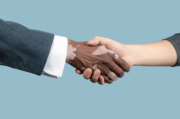 Close up of male hands with vitiligo pigments isolated on blue studio background.