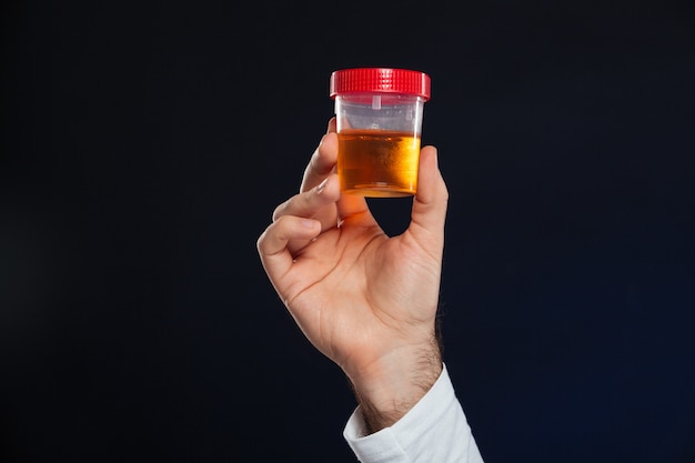 Close up of male's hand holding container with urine sample