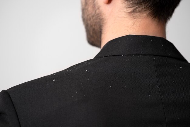 Close up man with dandruff problems