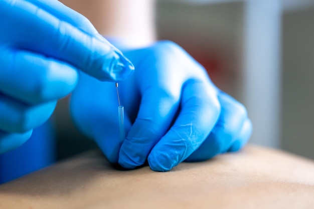 Free photo close up of a needle and hands of physiotherapist doing a dry needling