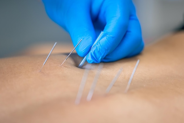 Free photo close up of a needle and hands of physiotherapist doing a dry needling