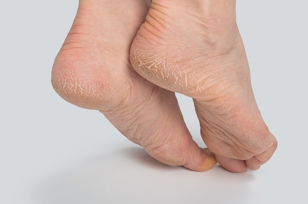 나쁜 피부가 덮여있는 발 뒤꿈치에 균열을 닫습니다. 의료 및 의료 개념.