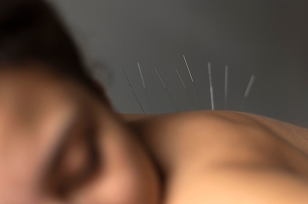 Free photo close-up patient during acupuncture procedure