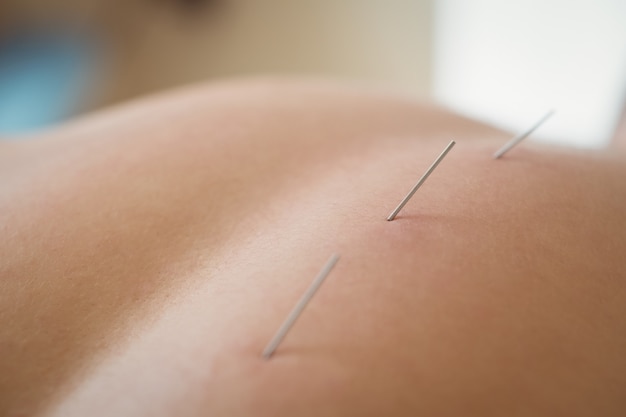 Close-up of a patient getting dry needling