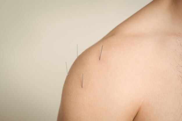 Close-up of a patient getting dry needling