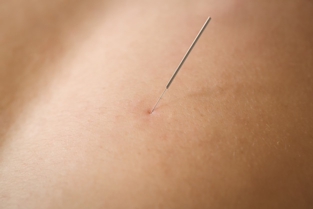 Free Photo close-up of a patient getting dry needling