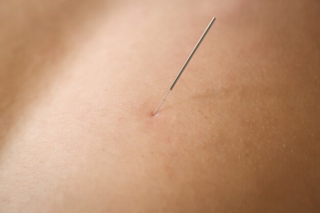 Close-up of a patient getting dry needling