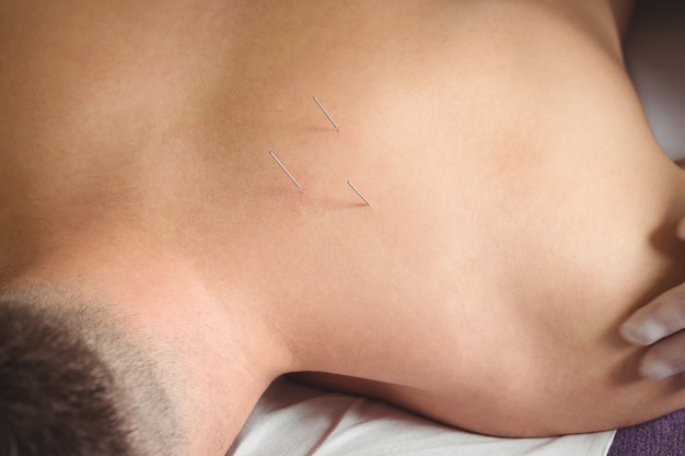 Free photo close-up of a patient getting dry needling