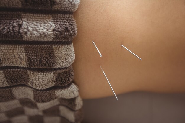 Free photo close-up of a patient getting dry needling