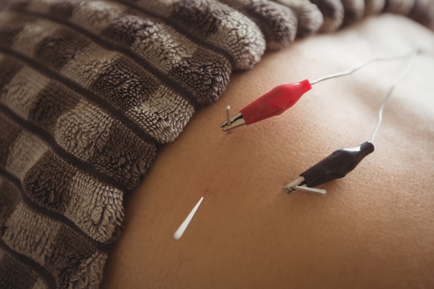 Free photo close-up of patient getting electro dry needling