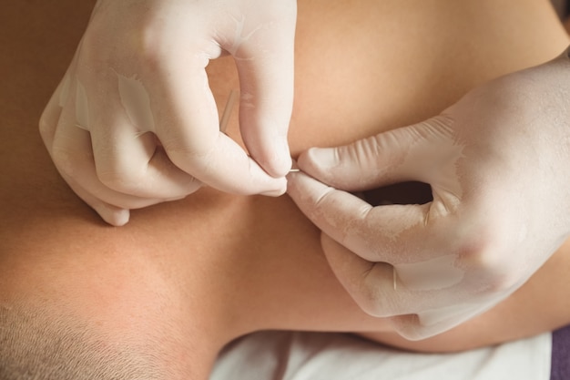 Close-up of Physiotherapist performing dry needling on patient