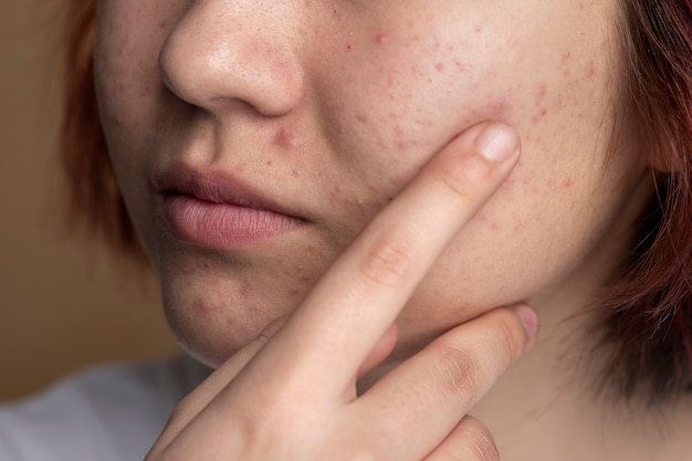 acne treatments for acne by air pollution