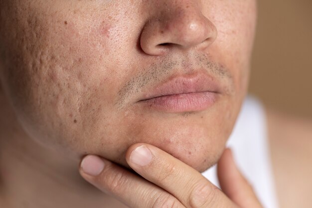 Close up on skin pores during face care routine