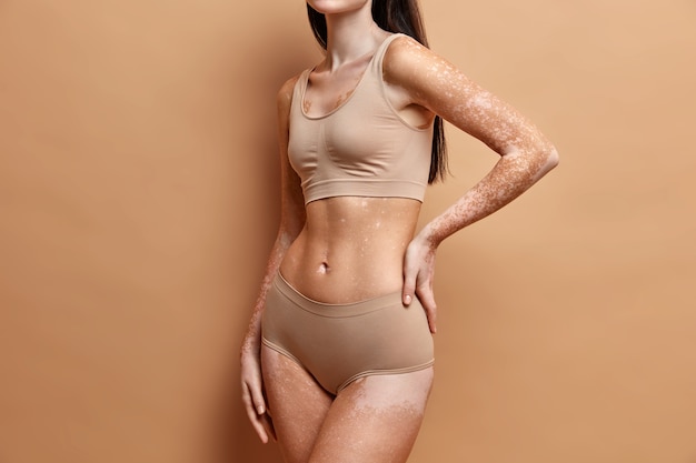 Free photo close up on slim woman with vitiligo skin