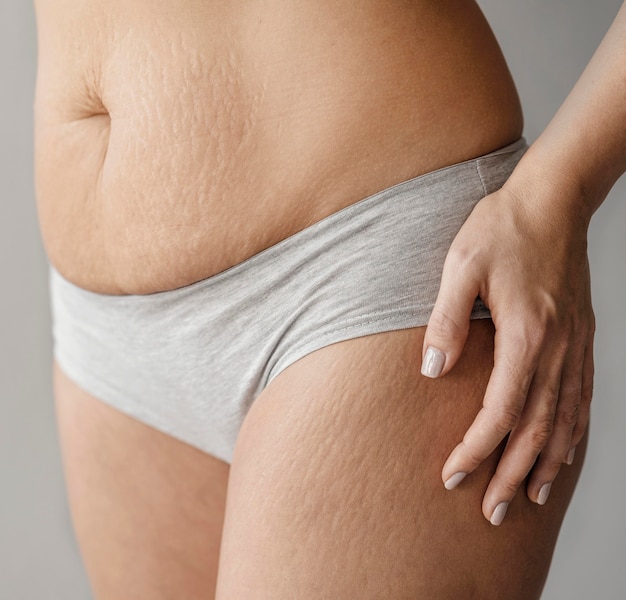 Close up woman body with stretch marks