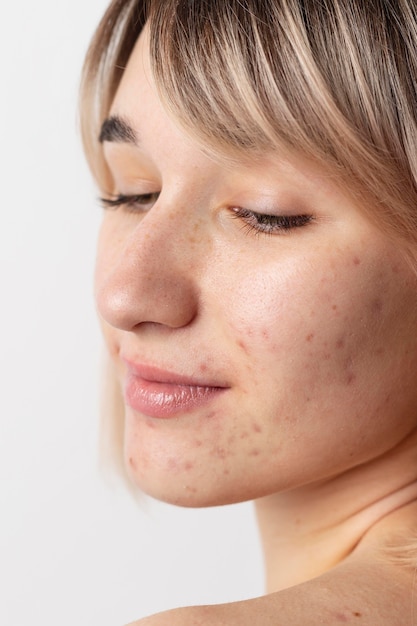 Foto gratuita chiuda sulla donna con la posa dell'acne