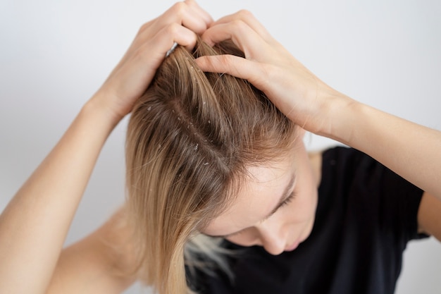 Close up woman with dandruff issues