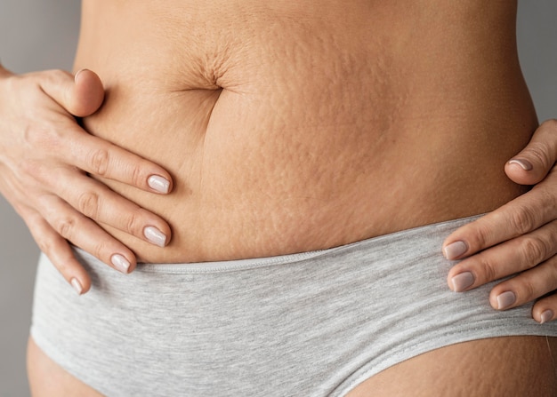 close up woman with stretch marks