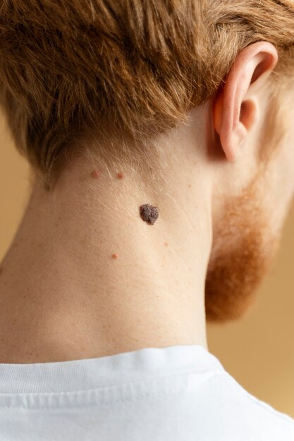 close up young man with mole on neck