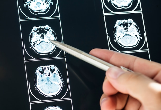 Free Photo closeup of brain mri scan result