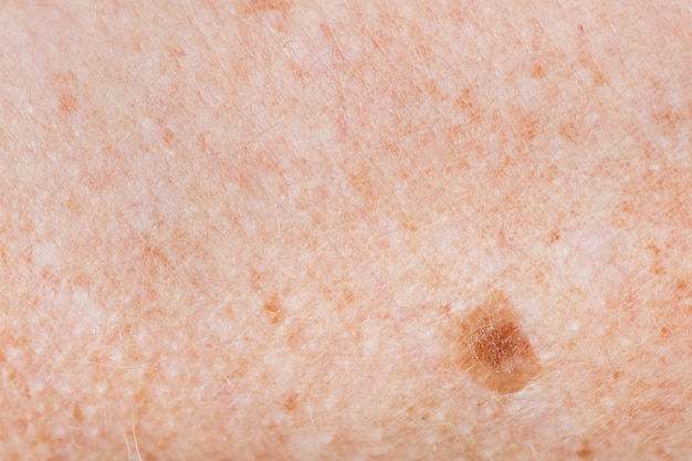 Closeup of freckled skin